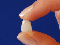 Veneers - Keramische Schalen