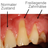 Freiliegende zahnhälse