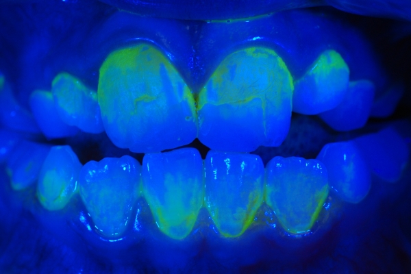 Zahnbelag sichtbar mit UV-Licht