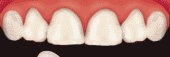 Veneers